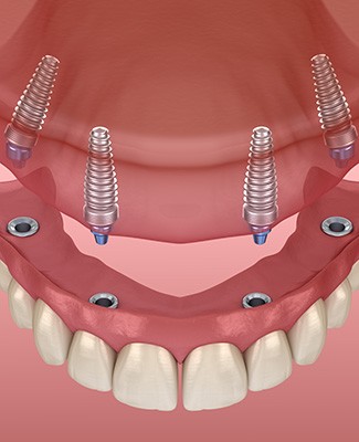 Digital image of All-on-4 implants for upper dental arch