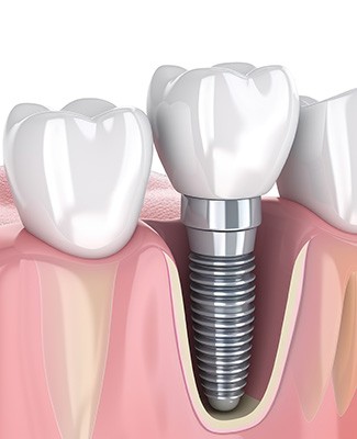 Traditional dental implant between natural teeth