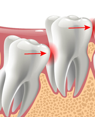 picture of an impacted wisdom tooth