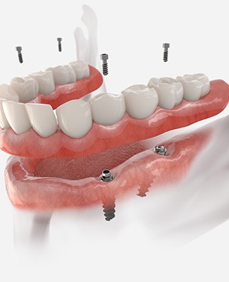 Illustration of implant dentures in Federal Way, WA being placed in lower arch