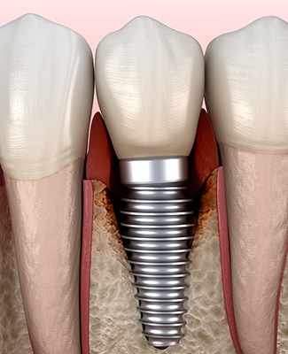 Digital image of infection around a dental implant