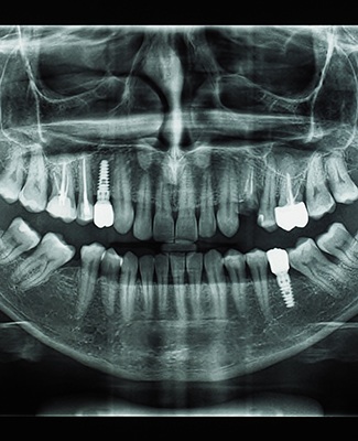 Dental implants displayed on x-ray