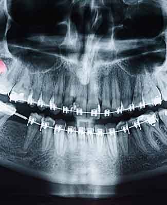 X-ray image of a mouth with 4 wisdom teeth colored red