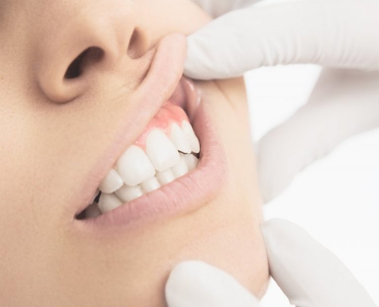 white-spots-on-gums-federal-way-dentist-federal-way